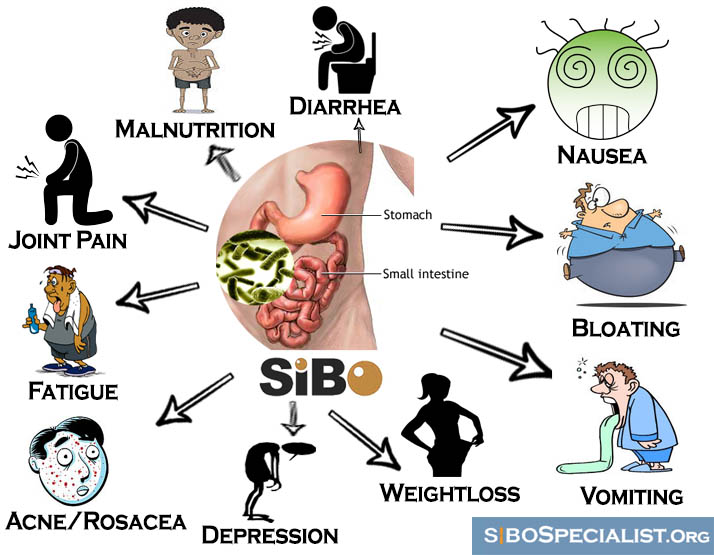 SIBO – Vékonybélfertőzés, ahogy én látom